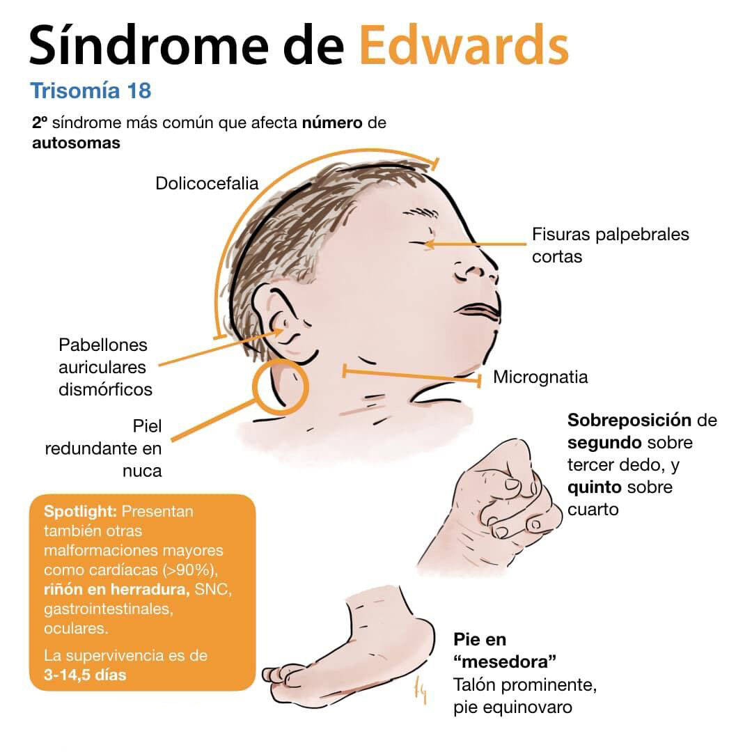DIA MUNDIAL DEL SINDROME DE EDWARDS O TRISOMIA 18 - Grupo Comercial Orthos